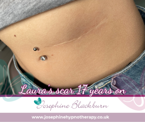 Laura's scar 17 years on. Hypnotherapy helped my birth trauma