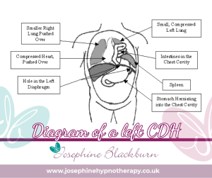 diagram showing a left CDH. Hypnotherapy helped my birth trauma.